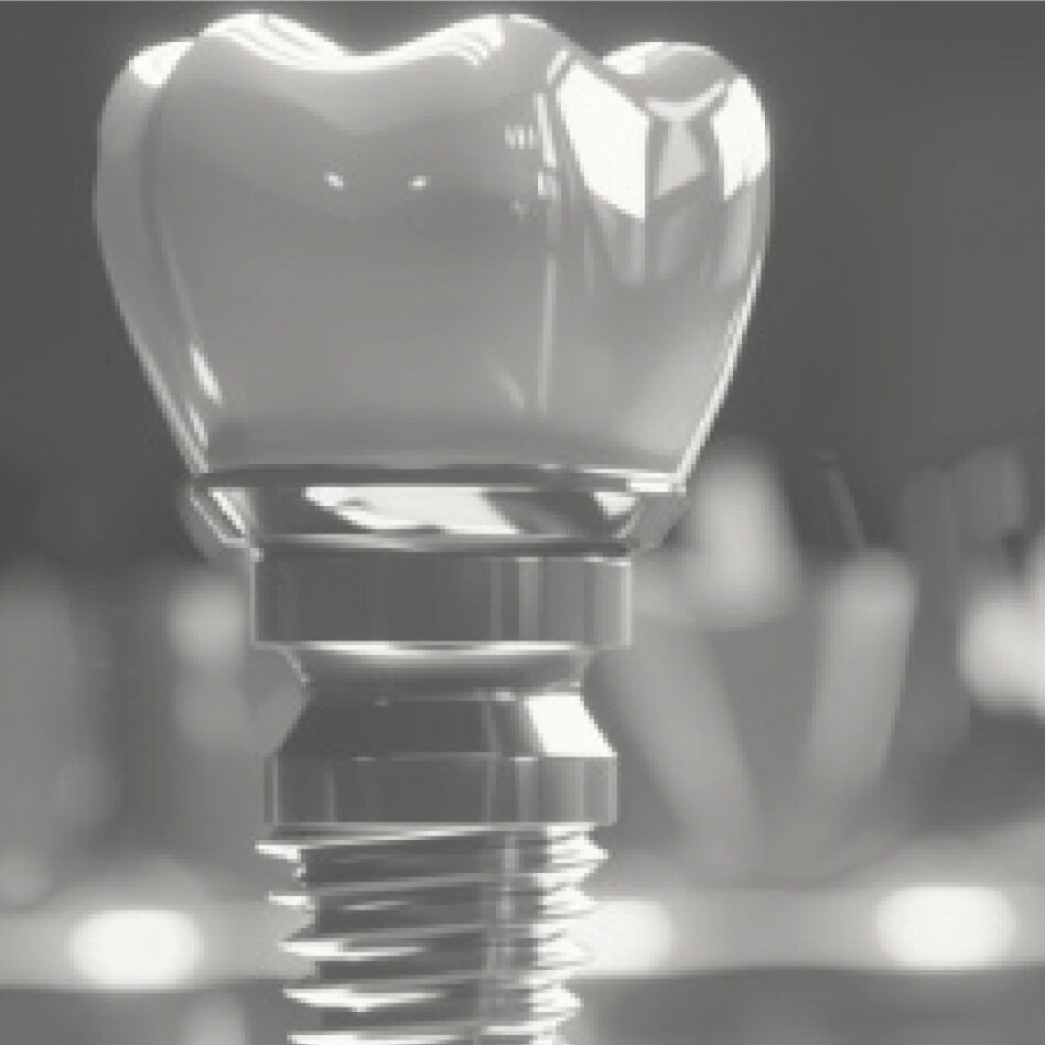 range-14-10 Close-up of a dental implant, showcasing the intricate details of the metal screw base and tooth-shaped cap in grayscale, highlighting the precision of dental implant attachments.