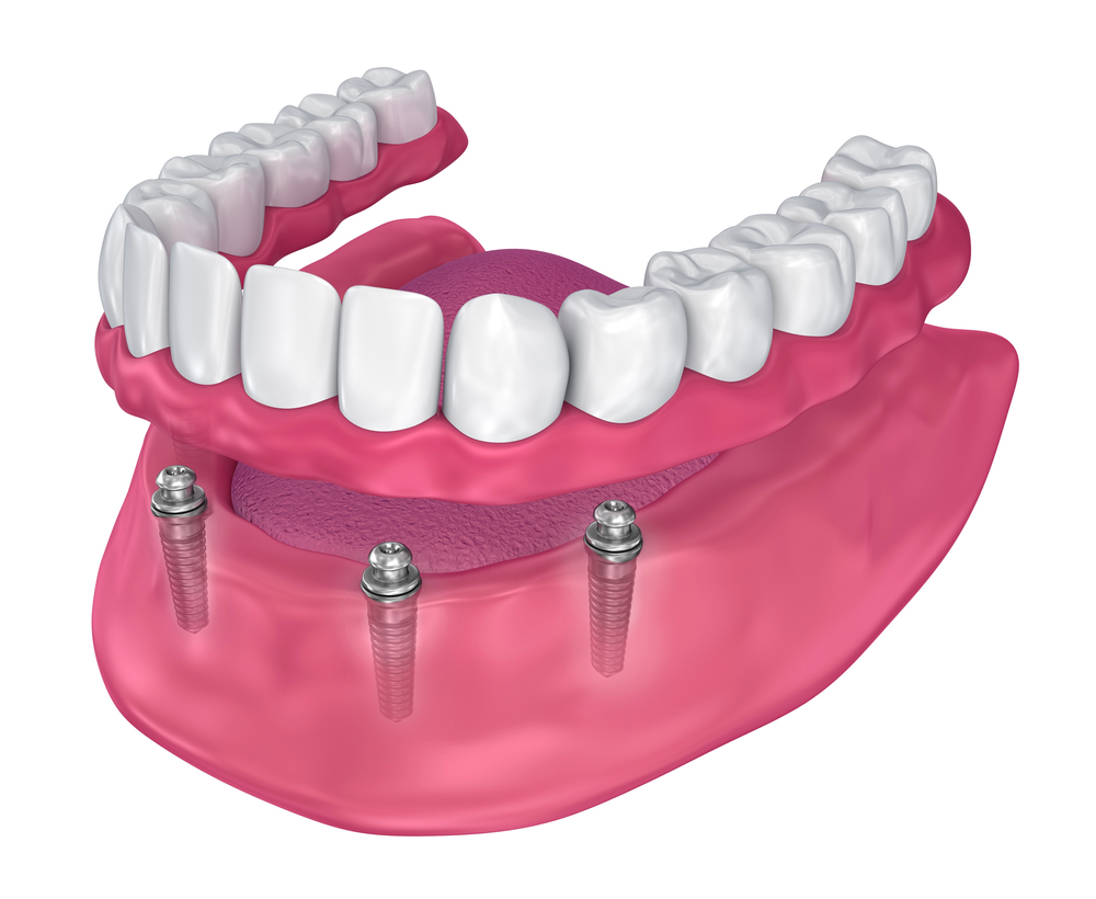 3D illustration of a lower jaw with dental implants and a full row of artificial teeth attached to the implants.