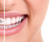 Close-up of a person's smile, showing a split image with metal braces on the left side of the teeth and straight, brace-free teeth on the right side.