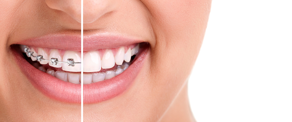 Close-up of a person's smile, showing a split image with metal braces on the left side of the teeth and straight, brace-free teeth on the right side.
