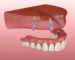 3D illustration of an upper dental prosthesis supported by four dental implants anchored in the jawbone, showing their placement and structure.