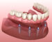 Digital illustration showing a full lower dental arch supported by four dental implants inserted into the jawbone.